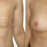 Ricostruzione seno dopo mastectomia prima e dopo